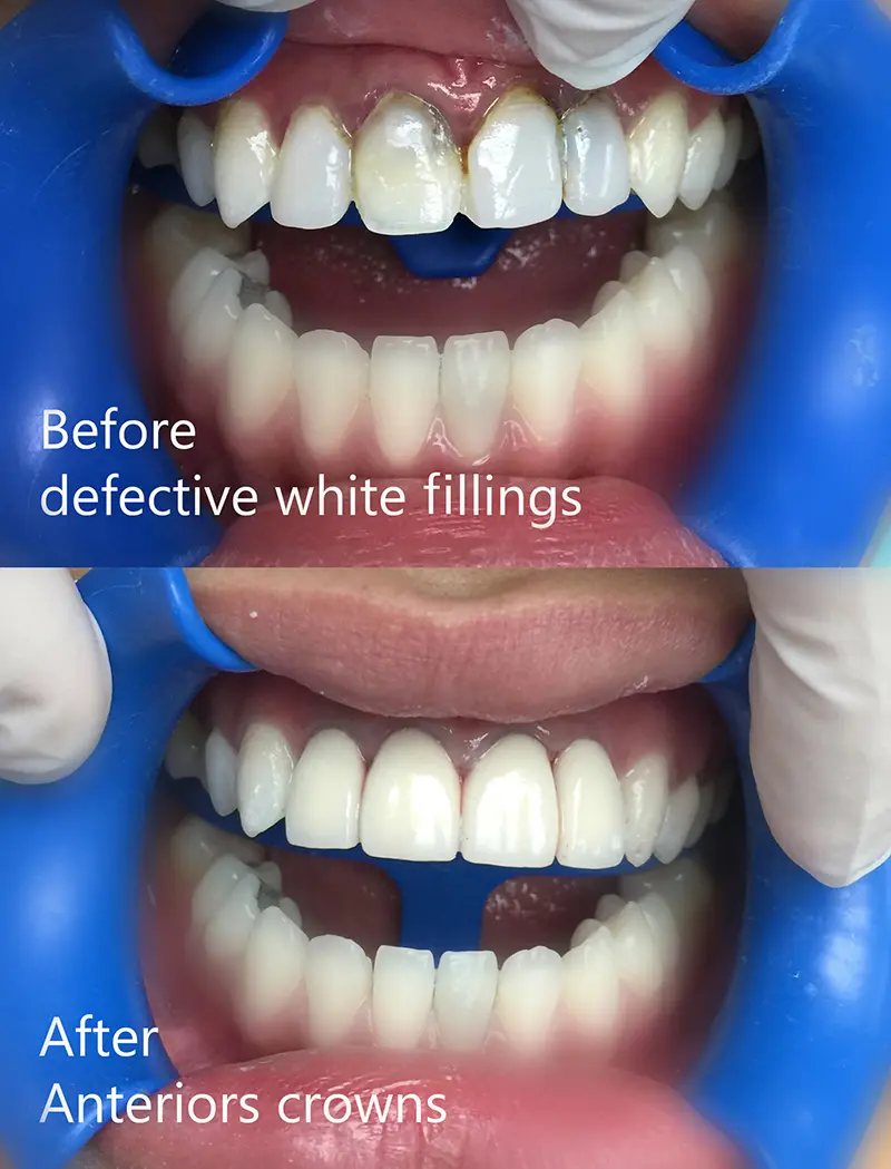 Cosmetic Veneers & Crowns 2